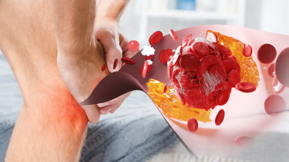 Gejala Penyakit Asam Urat